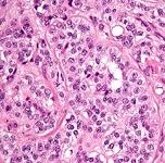 Picture of a tumour for Your Expert Witness story