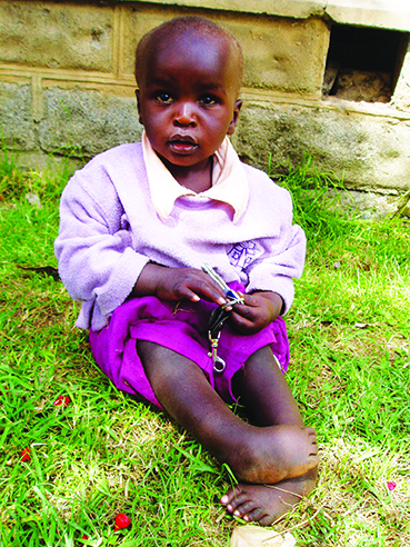 Clubfoot